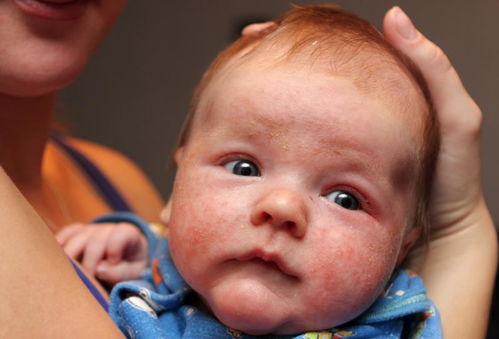 怎样预防婴儿脸上湿疹的发生