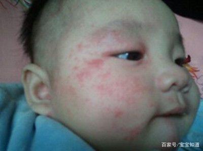 怎样预防婴儿脸上湿疹的方法